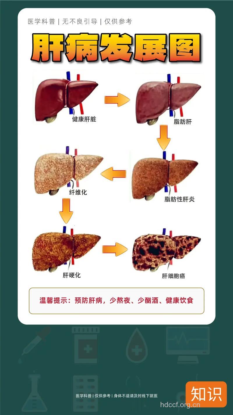乙肝治疗全景:肝硬化、肝癌是慢性乙肝发展的最终阶段