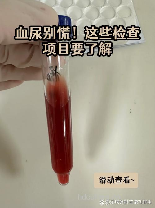 血尿的最新检查方法