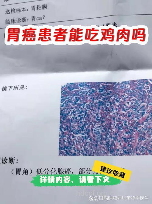 晚期胃癌患者吃鸡肉好吗