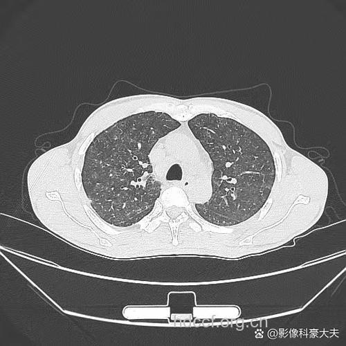 心理CT透视是否健康
