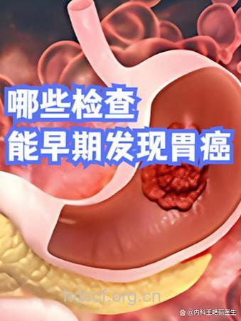 要如何检查是否患上胃癌