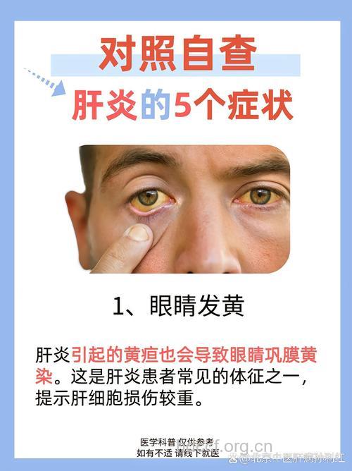 黄疸就一定是得了肝炎吗?