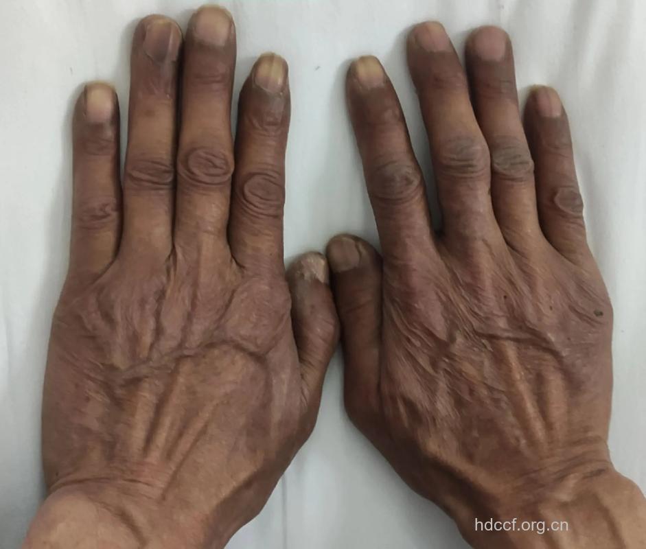 胃癌晚期会毛发脱落吗