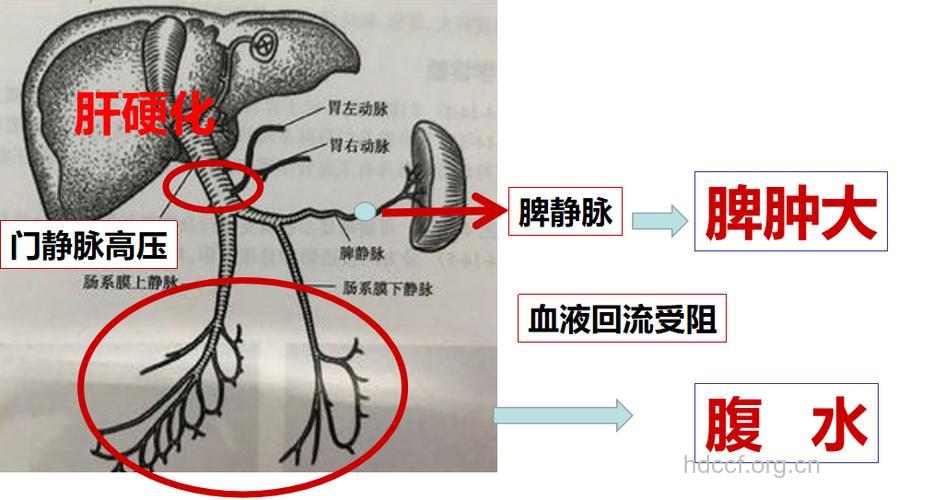 肝腹水的形成过程