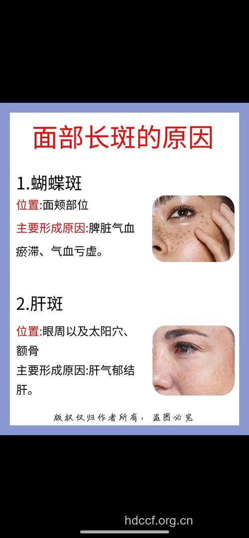长蝴蝶斑应怀疑有肝病