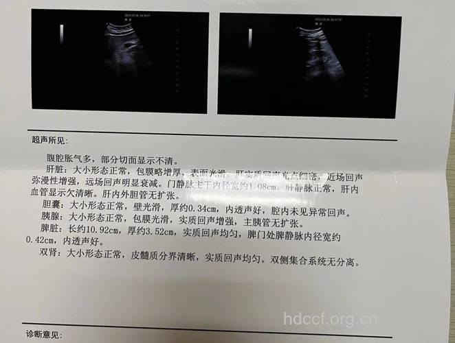 Ｂ超显示的肝脏大小准不准？