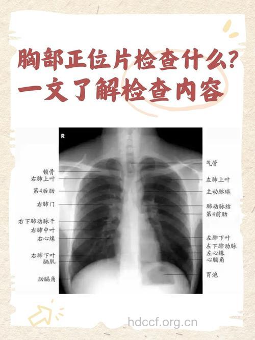了解胸部x光检查的一些常识