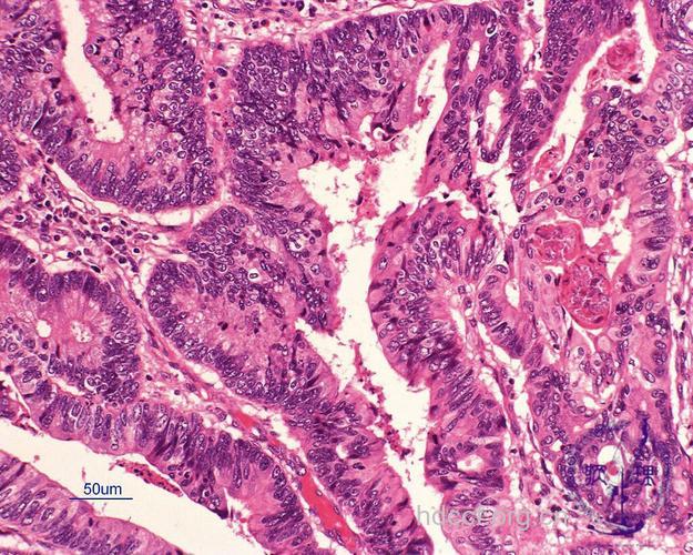 中晚期胃癌的病理特征