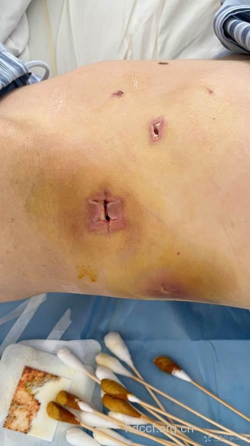 惊!伤口可导致感染乙肝