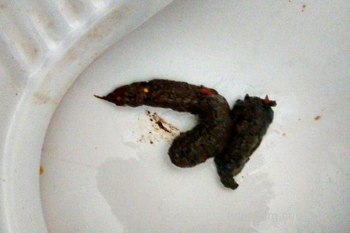 黑便是胃癌的早期症状吗