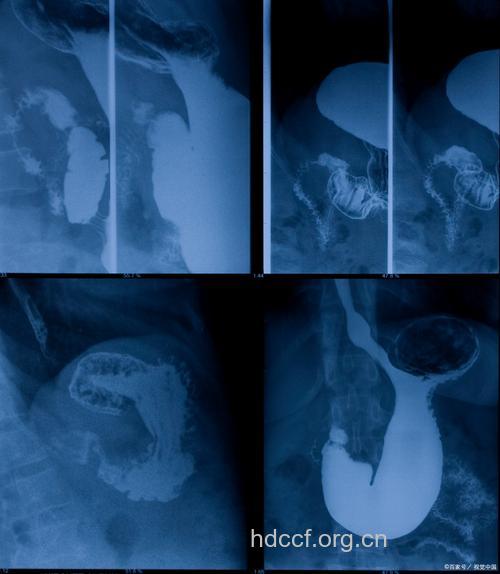诊断胃癌不妨做X线检查