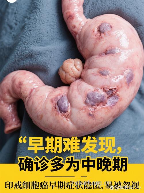 四类“隐形盐”诱发胃癌