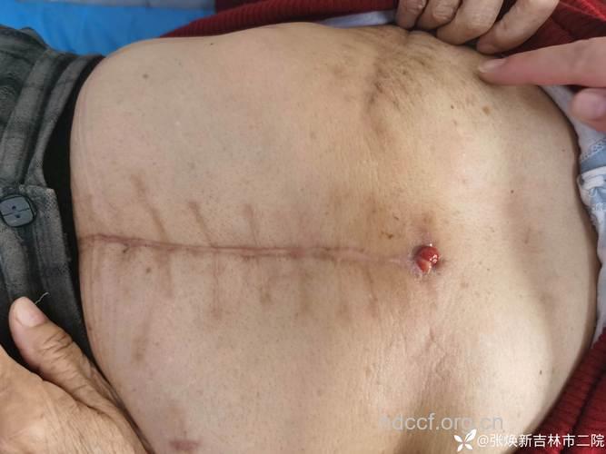 早期胃癌手术后的预后