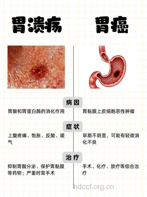 如何识别胃癌与胃溃疡
