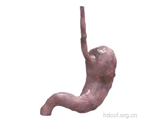 “皮革胃”其实是胃癌！