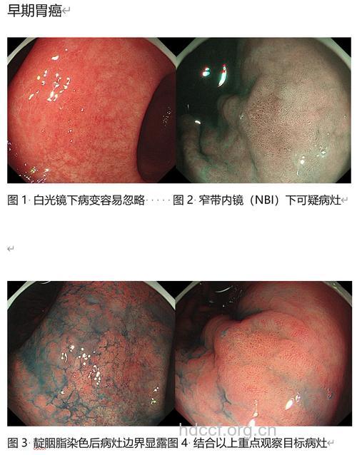 4种检查可发现早期胃癌