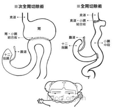 贲门癌切除胃的范围