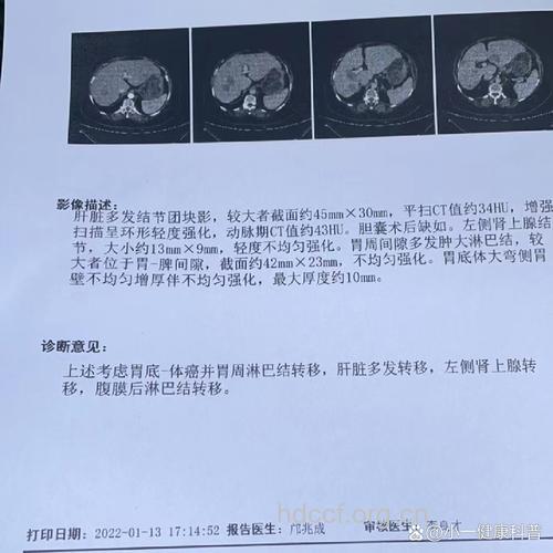 胃癌检查结果怎样看?