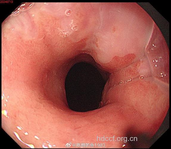 贲门癌恶化期症状