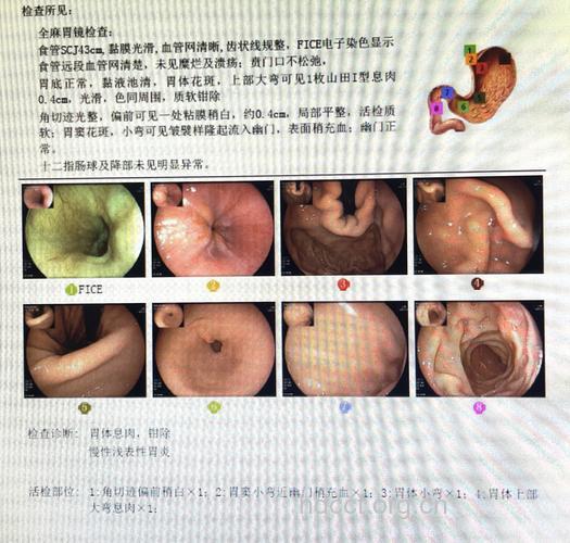 哪些人需定期胃镜检查排除胃癌