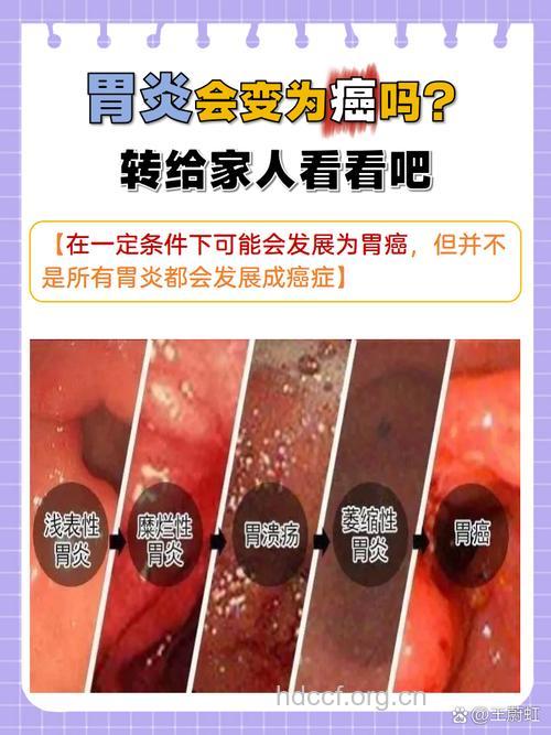 胃部癌前病变生不是癌