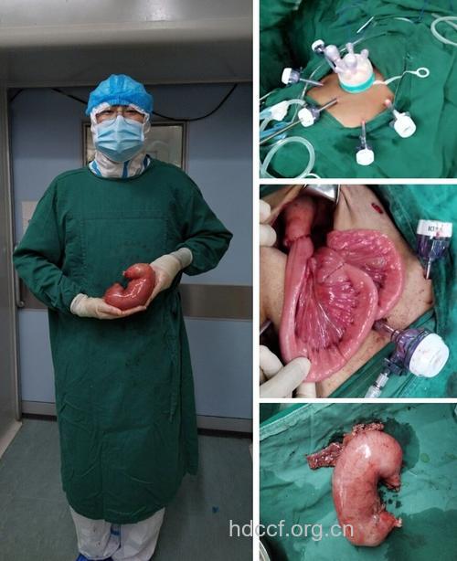 胃癌根治术手术全过程