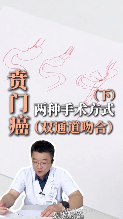 专家详谈贲门癌手术