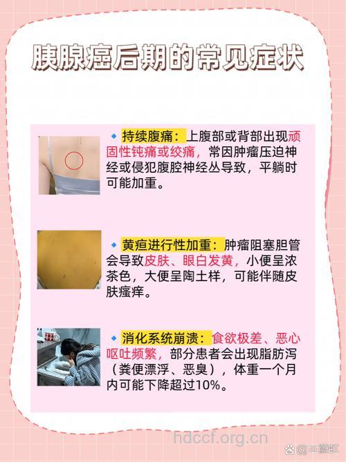 胰腺癌晚期有哪些症状