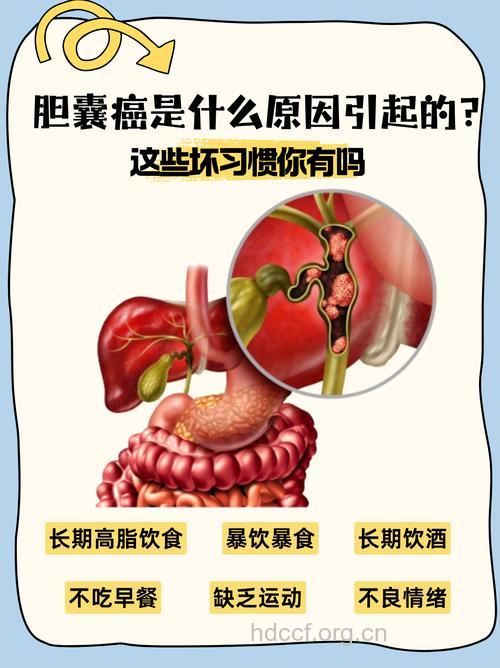 胆石症会诱发胰腺癌吗