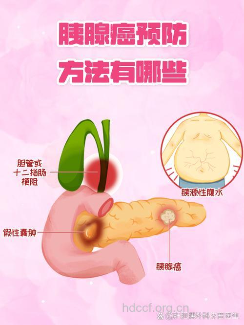 怎么认识胰腺癌从病因开始