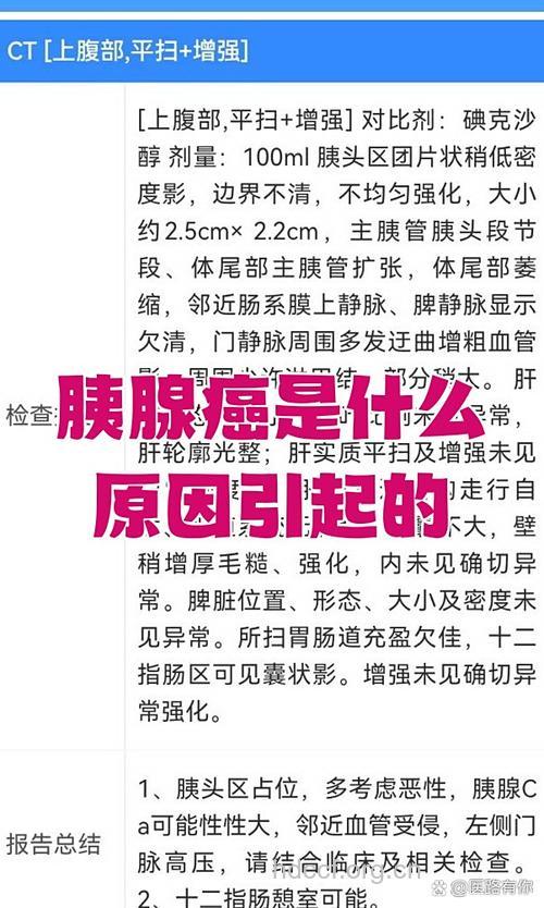 长期吸烟是诱发胰腺癌的原因吗