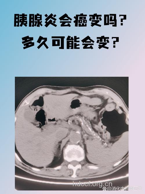胰腺炎会癌变成胰腺癌吗
