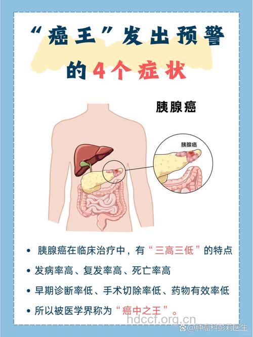 早期胰腺癌症状是什么呢