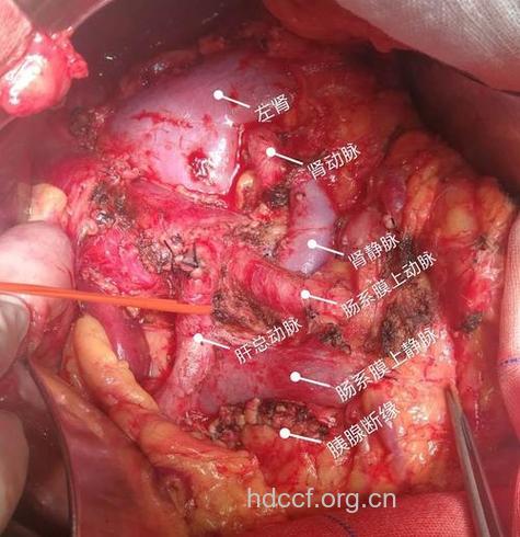 晚期胰腺癌症状是什么