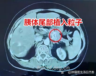 胰腺癌肺的血行转移症状