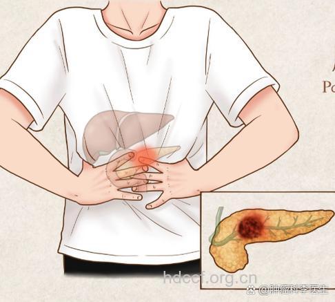 胰腺癌为何比较隐蔽