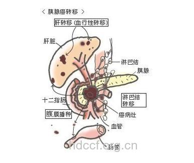 胰腺癌有哪些转移途径