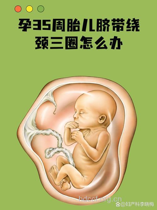 孕期检查：早期发现胎儿脐带绕颈