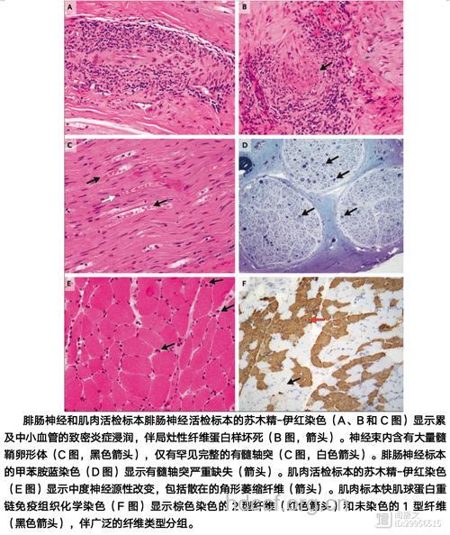 胰腺多肽瘤的病理变化