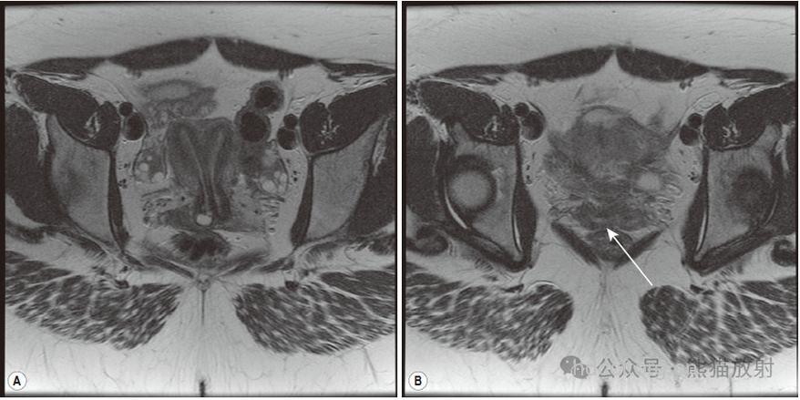 案例：女性生殖道畸形导致不孕