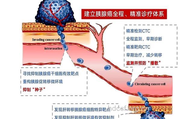 胰腺癌患者“与瘤共存”疗法