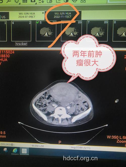 带你了解卵巢癌的影像学诊断