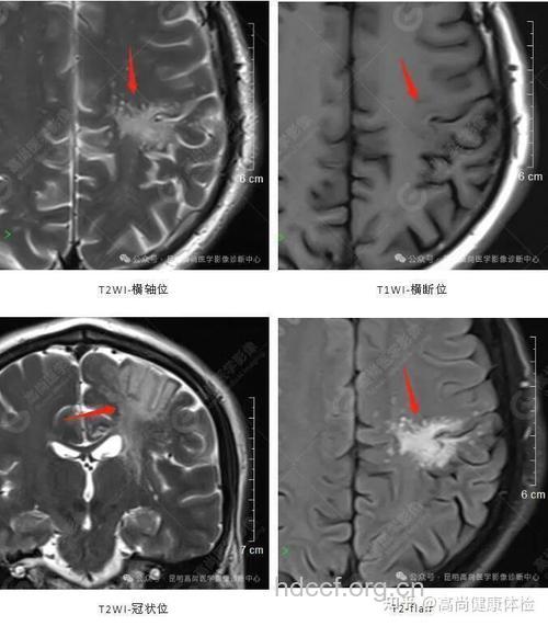 脑白有哪些临床表现