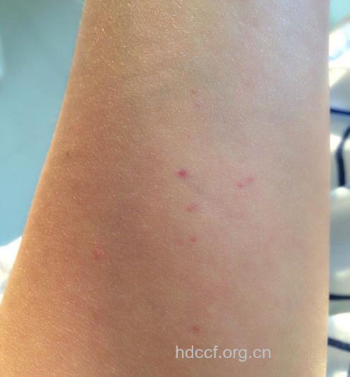 白血病早期症状有哪些？