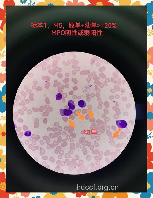 白血病的病理