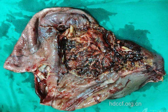 肝包虫病症状有哪些