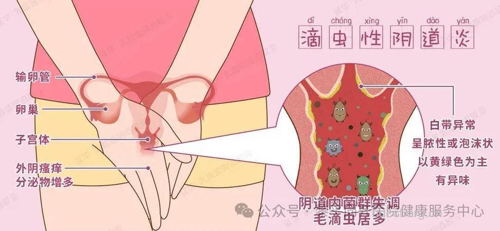 女性如何正确认识阴道炎