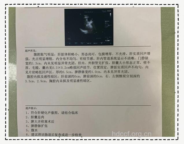 一个肝硬化病例