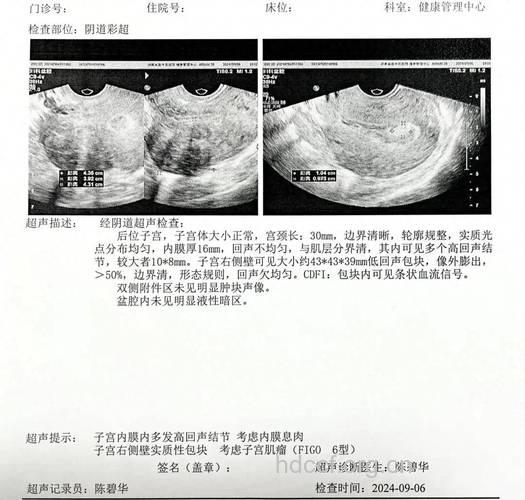 肚大如六甲女子入院检查却是子宫肌瘤