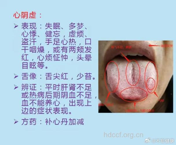 中医舌诊治疗脂肪肝